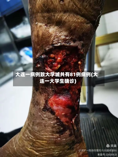 大连一病例致大学城共有81例病例(大连一大学生确诊)-第2张图片
